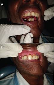 Chemotherapy, hormone therapy, and immunotherapy target the main cancer. Stages Of Oral Cancers Images Associated With Tobacco And Other Social Behaviours Among Patients In Banglore State India