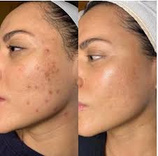 In Alex Alexa Medical Spa we offer a procedure called Micro-needling that  is a very versatile procedure. It helps multiple skin concerns, including  pore size, scarring, stimulates collagen formation, overall skin tone,