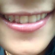 Porslen akrilik mulai dari = rp. Teguh Dental Ahli Pasang Gigi Palsu Dan Behel Home Facebook