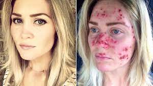 It affects people of all races, genders and ages, which is why it's absolutely critical for americans to learn about. Woman S Skin Cancer Selfies Go Viral And Inspire Skin Checks Allure