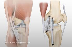 Signs and symptoms of a medial collateral ligament (mcl) injury include swelling, pain, stiffness, and a feeling that the knee may give facts you should know about medial collateral ligament (mcl) injury. Medial Collateral Ligament Mcl Tear Chicago Il Jorge Chahla Md