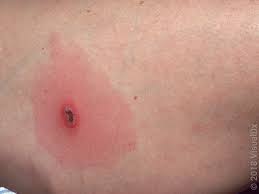 Image result for wolf spider bite skin
