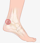 Foot Ailments Heel Achilles Tendonitis Footsmart