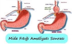 mide fitigi nedir belirtileri tedavisi ve ameliyati saglik haberleri saglik