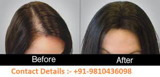 This doesn't include any costs associated with taking time off of work, gas money or any other inconvenient factors that decrease your annual revenue. Digital Marketing Services In Gorakhpur Gkp Prp Laser Treatment Cost For Hair Loss Chennai 9810436098