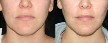 After losing weight she now regrets it and feels that it caused her to age prematurely. Buccal Fat Removable And Cost At Dental House Dublin