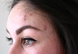 Welke pil werkt goed tegen acne. Acne Behandeling Bij Laserskinclinics Beautylab Nl