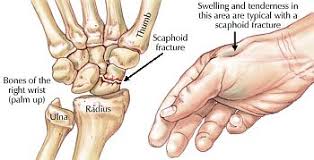 Image result for Scaphoid Fracture