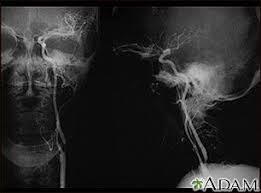 Estenosis Carotidea Radiografia De La Arteria Izquierda Medlineplus Enciclopedia Medica Illustracio Subarachnoid Hemorrhage Brain Aneurysm Awareness Stenosis