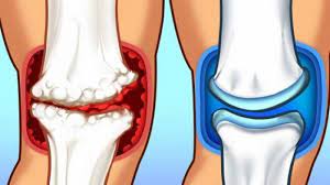 Check spelling or type a new query. Apa Itu Osteoartritis Atau Kelainan Sendi Kronis Berikut Penjelasan Hingga Cara Mengobatinya Halaman All Tribun Palu