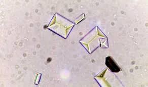 Urine Contains Many Dissolved Substances Solutes That The Body Needs To Eliminate As Waste Chemicals These Solu Types Of Crystals Medical Technology Crystals