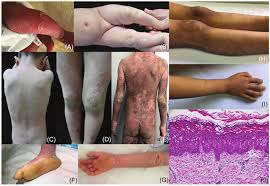Image result for Ichthyosis