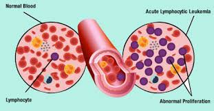 Based on blood cancer types, stages and blood cancer symptoms, blood cancer treatment is undertaken. Blood Cancer Types And Stages Indus Health Plus