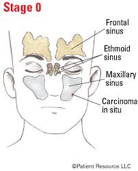 Image result for Maxillary Sinus