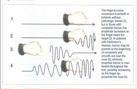 Image result for Rest Tremor