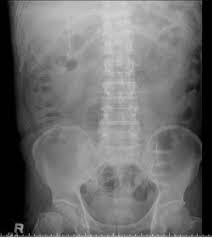 Plain X Ray Of Abdomen Shows The Tip Of The Vp Shunt Was Curling Over Download Scientific Diagram