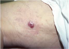 It is also known as trabecular cancer. Figure 1 From Merkel Cell Carcinoma A Virus Induced Human Cancer Semantic Scholar
