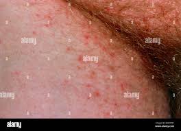 Image result for sore skin in the groin area