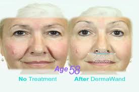 Microneedling has been studied for decades and, as such, there are the male had experienced this loss of hair for one year, while the female had experienced it for six months. 16 Derma Wand Ideas Derma Wand Saggy Skin Enlarged Pores