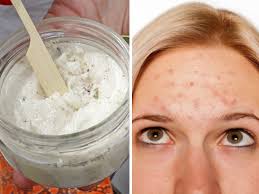 Mascarilla Para Granos De La Frente