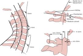 Anterior vertebral line, posterior vertebral line, spinolaminar line, posterior spinous line. Rwrjlooxmnpehm