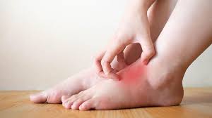 Trigaux jp, vandroogenbroek s, de wispelaere jf, lacrosse m, jamart j. Dermatitis Stasis Kulit Meradang Akibat Sirkulasi Di Kaki Yang Tak Lancar