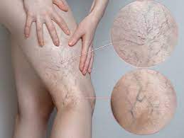 متخصص درمان واریس در تهران | کلینیک قلب دکتر نجفی