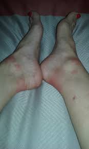 Bed Bug Photos Clipart Images Pics What Do Bed Bugs Look Like With long legs, a glossy black abdomen. bed bug photos clipart images pics