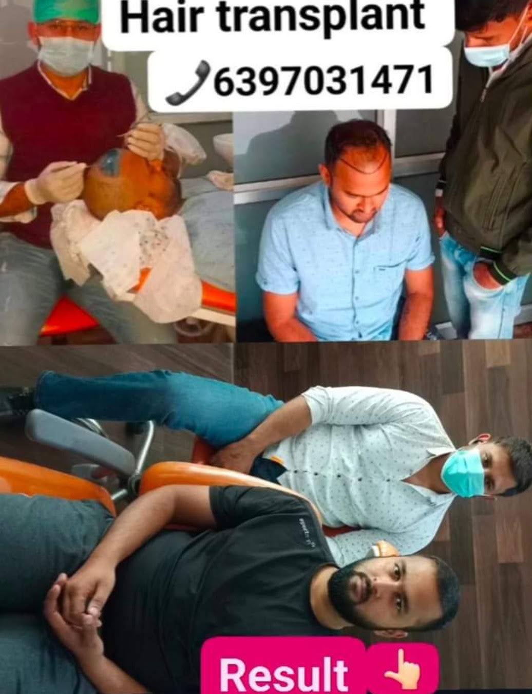 Hair transplant product image