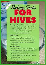 Home Remedies For Hives Include Baking Soda Aloe Vera Apple Cider Vinegar Ginger Green Tea Home Remedies For Hives Hives Remedies Natural Healing Remedies