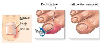 Read about symptoms, home treatment, complications, foot surgery, causes, and nail removal. Ingrown Toenails Causes Symptoms And Treatment Wbw 888