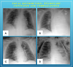 Image result for Pulmonary Contusion