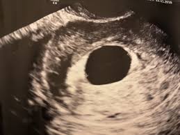 What are the treatment options? Unconfirmed Blighted Ovum Babycentre