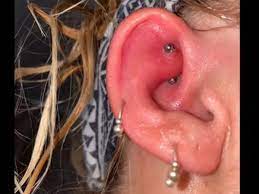 Taking your earrings out every night will give your ears a. Woman S Piercing Gets Infected Doctors Create New Antibiotic To Treat Woman S Infected Ear Piercing After Nothing Else Worked Trending Viral News