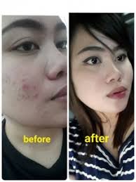 Glow skincare products bring out your skin's. Salun Kecantikan Baiduri Testimoni Glow Glowing