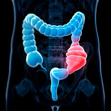 While it's true that these bowel cancer symptoms may be common in other conditions, it's advisable to go to a specialist if you have two or more of them. Can Viagra Help Protect Against Colon Cancer Death In Men Medicinenet Health News