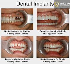 Dentalimplant Surgery Is A Procedure That Replaces Tooth Roots With Metal Screwlike Posts And Replaces Damaged Or M Dental Implants Tooth Implant Cost Dental