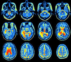Cpt code for pet scan skull to mid thigh 78811 positron emission tomography (pet) imaging; Pet Scans And Alzheimer S Bluegrass Regional Imaging