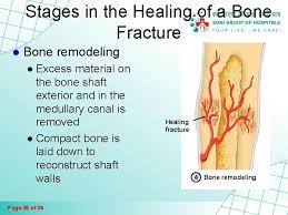 Fractures And Bone Healing Page 1 Of 39