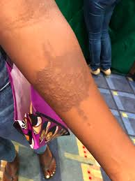 Why is the risk being highlighted now? Warning Of The Harms Of Black Henna Henna Blog Spot