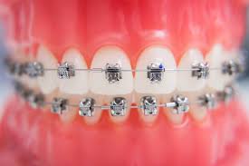 For the majority of patients, teeth straightening with dental braces may take anywhere between just 6 months and 2 years. How Long Does It Take To Straighten Teeth With Braces Sweet Smile Dental Clinic