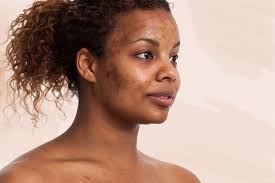 It usually takes about a week or maybe more in some cases. How Long Does It Take For Acne Scars To Fade Skin Care Geeks