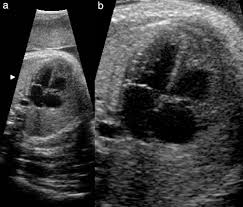 The Four Chamber View Four Reasons Why It Seems To Fail In Screening For Cardiac Abnormalities And Suggestions To Improve Detection Rate Chaoui 2003 Ultrasound In Obstetrics Amp Gynecology Wiley Online Library Heart ultrasound provides your doctor with moving images of your heart and takes excellent pictures that will help your doctor evaluate your heart health. the four chamber view four reasons why