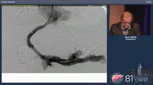 Repermeabilisation De La Veine Porte Traitement Radiologique A Denys Youtube