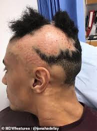 A couple months ago the hair loss started again and was terrible. Asos Model S Career Was Almost Ruined When Alopecia Made Him Lose 70 Of His Hair Express Digest