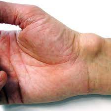 Ganglion Uberbein Symptome Ursache Behandlung Der Spiegel