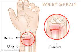 Wrist Sprain - Causes, Symptoms, Diagnosis, Treatment