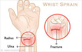 But that's a rough estimate. Wrist Sprain Causes Symptoms Diagnosis Treatment