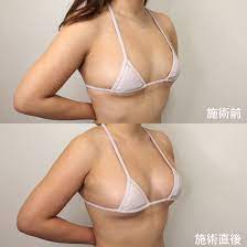 ヒアルロン酸豊胸で手軽にボリュームアップ！｜症例写真・ビフォーアフター｜美容整形・美容外科のTAクリニックグループ