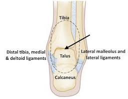 Deltoid ligament rupture or medial malleolus avulsion fracture. Emdocs Net Emergency Medicine Educationem Cases Commonly Missed Ankle Injuries Emdocs Net Emergency Medicine Education